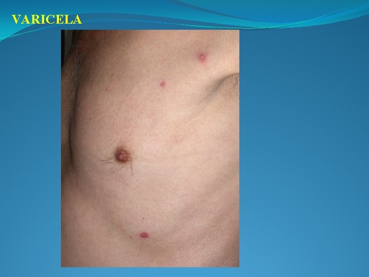VARICELA 
