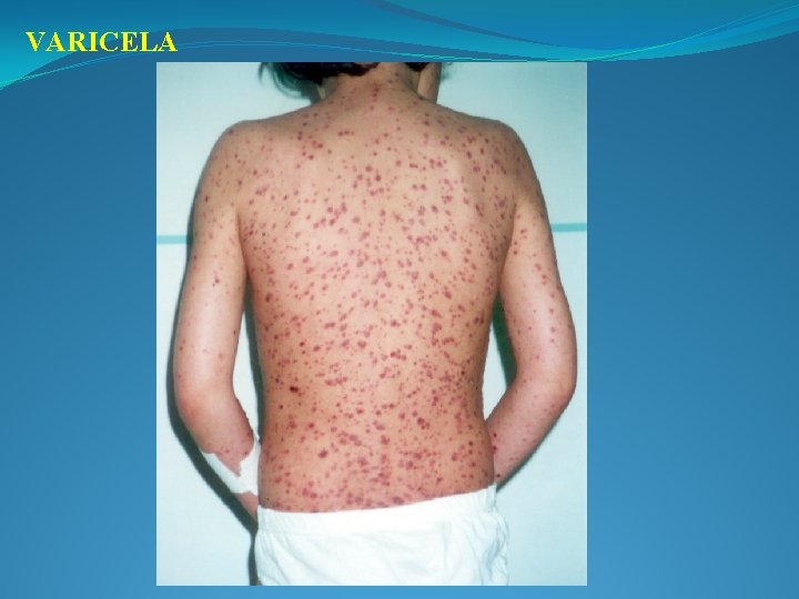VARICELA 