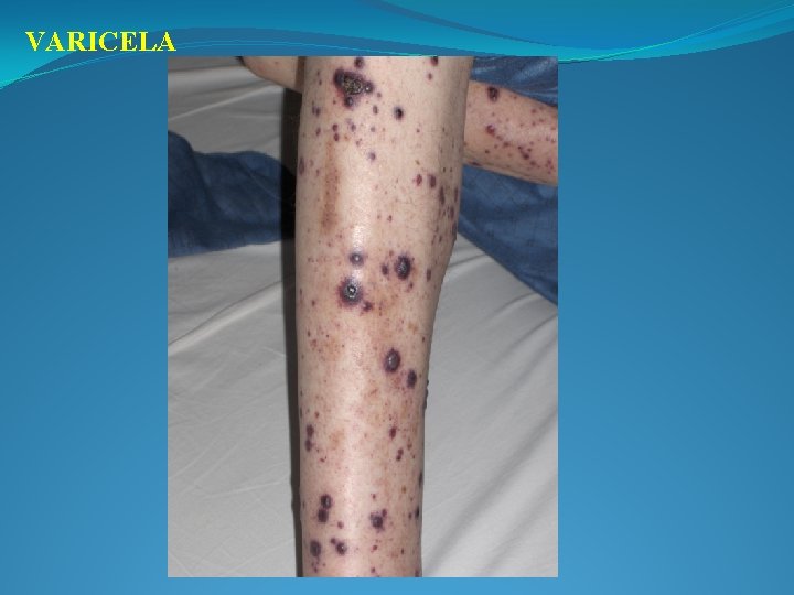 VARICELA 
