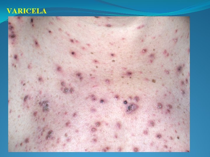 VARICELA 