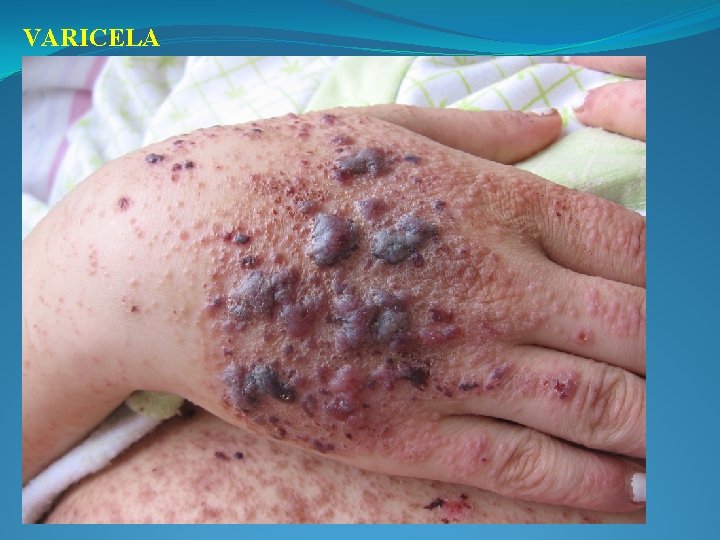 VARICELA 