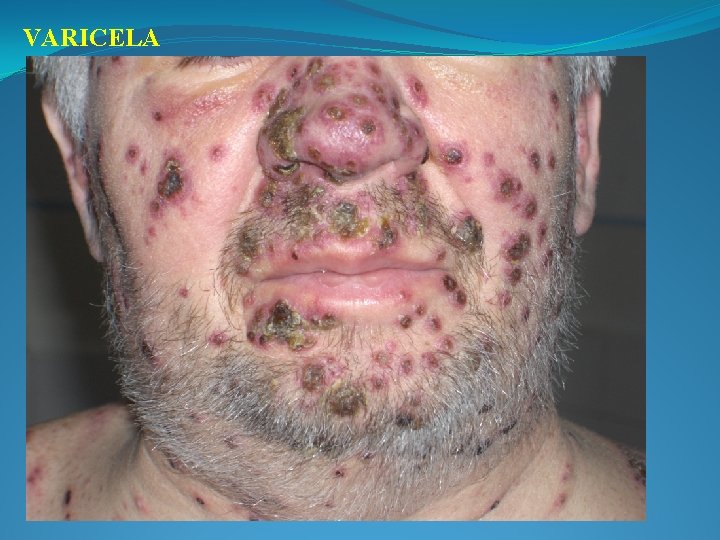 VARICELA 
