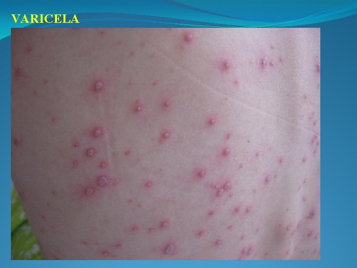 VARICELA 