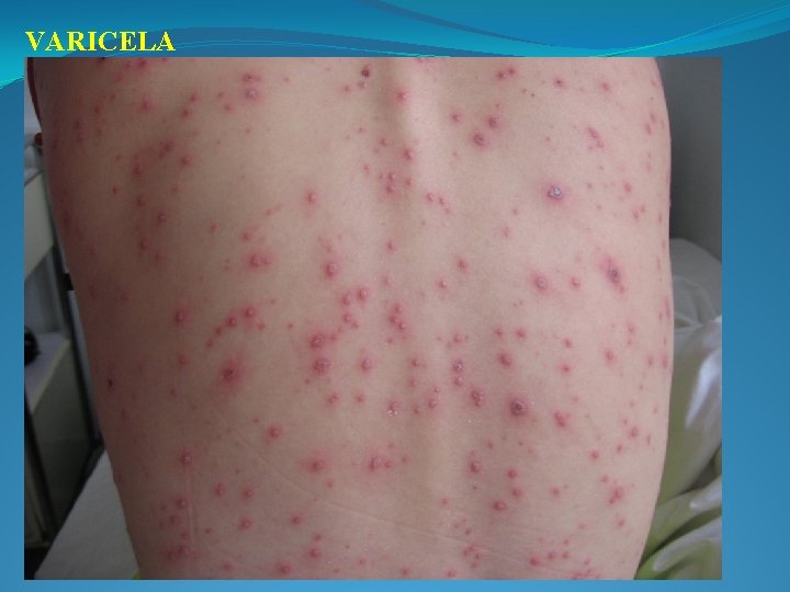 VARICELA 