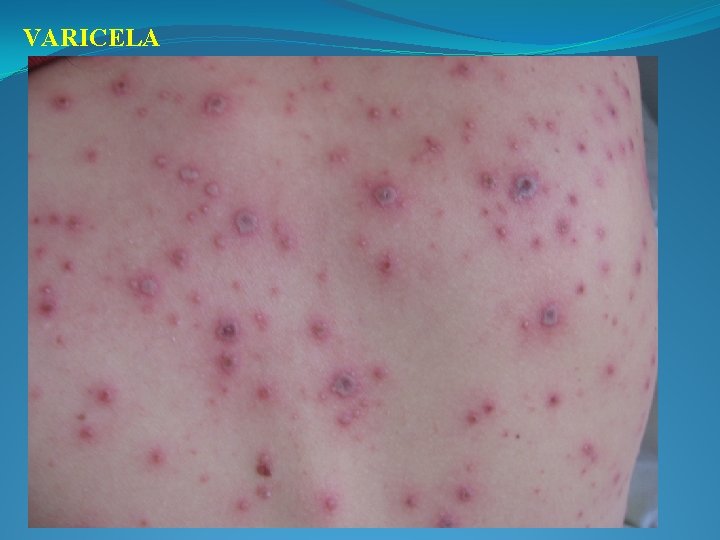 VARICELA 