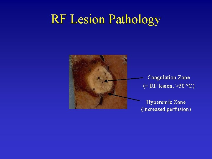 RF Lesion Pathology Coagulation Zone (= RF lesion, >50 °C) Hyperemic Zone (increased perfusion)