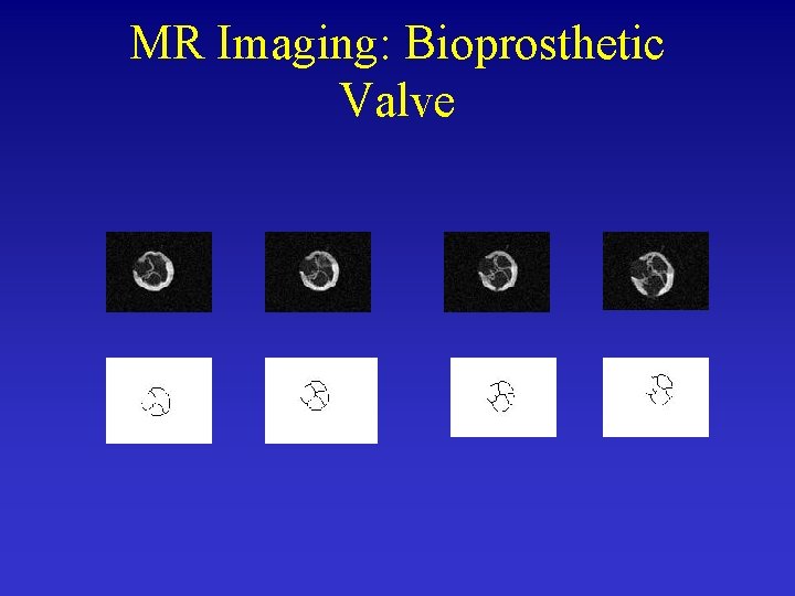 MR Imaging: Bioprosthetic Valve 