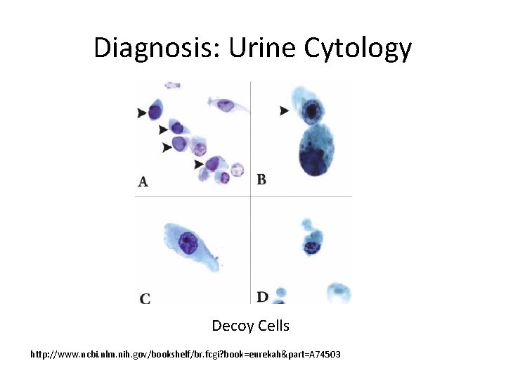 Diagnosis: Urine Cytology Decoy Cells http: //www. ncbi. nlm. nih. gov/bookshelf/br. fcgi? book=eurekah&part=A 74503