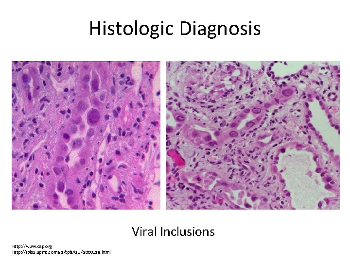 Histologic Diagnosis Viral Inclusions http: //www. cap. org http: //tpis 1. upmc. com: 81/tpis/GU/G