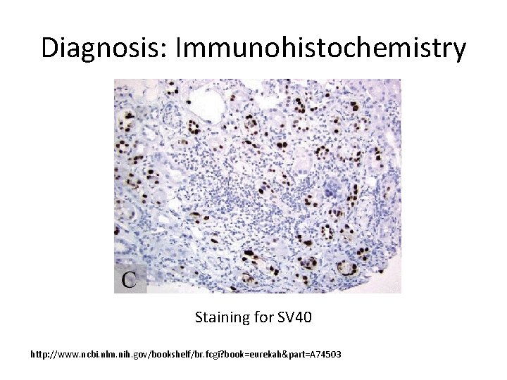 Diagnosis: Immunohistochemistry Staining for SV 40 http: //www. ncbi. nlm. nih. gov/bookshelf/br. fcgi? book=eurekah&part=A
