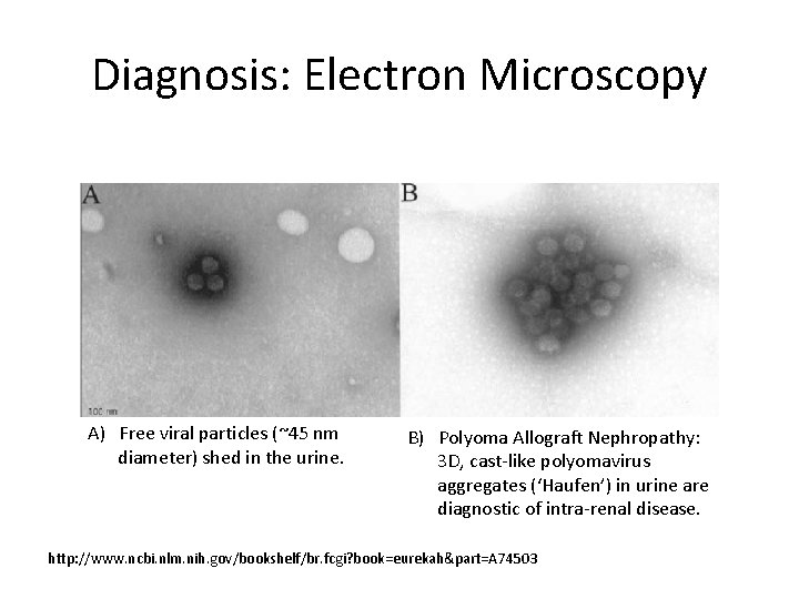 Diagnosis: Electron Microscopy A) Free viral particles (~45 nm diameter) shed in the urine.