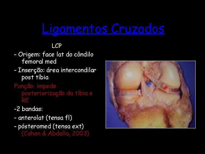 Ligamentos Cruzados LCP - Origem: face lat do côndilo femoral med - Inserção: área
