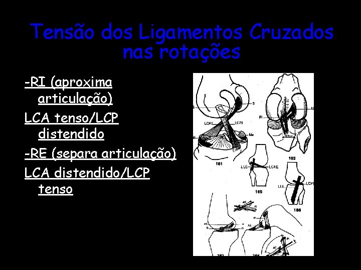 Tensão dos Ligamentos Cruzados nas rotações -RI (aproxima articulação) LCA tenso/LCP distendido -RE (separa