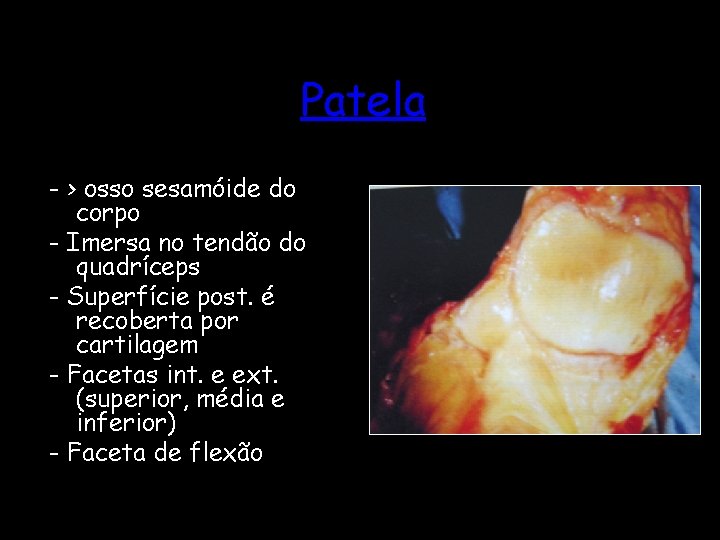 Patela - > osso sesamóide do corpo - Imersa no tendão do quadríceps -