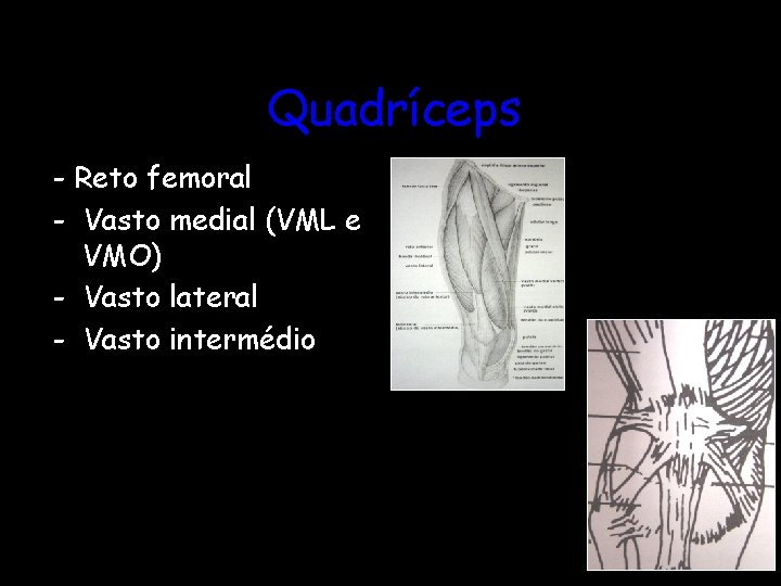 Quadríceps - Reto femoral - Vasto medial (VML e VMO) - Vasto lateral -