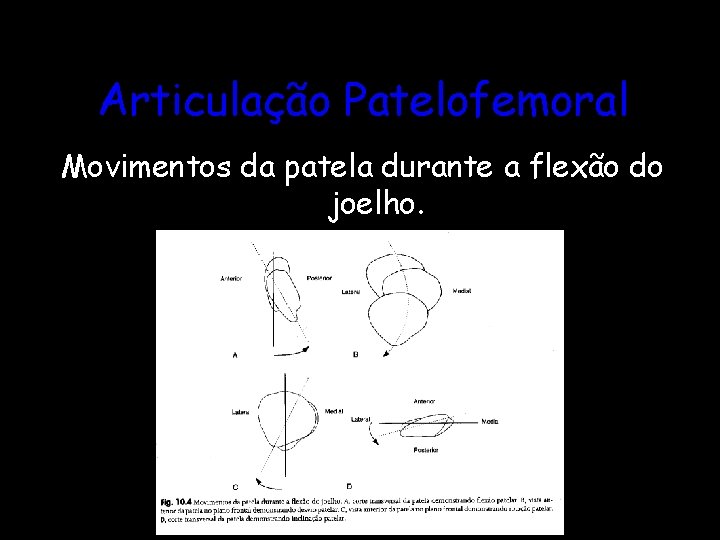 Articulação Patelofemoral Movimentos da patela durante a flexão do joelho. 