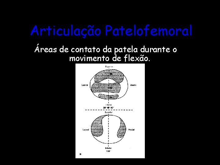 Articulação Patelofemoral Áreas de contato da patela durante o movimento de flexão. 