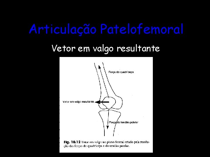 Articulação Patelofemoral Vetor em valgo resultante 