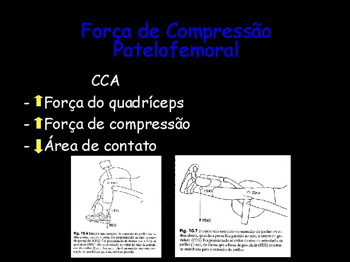 Força de Compressão Patelofemoral CCA - Força do quadríceps - Força de compressão -