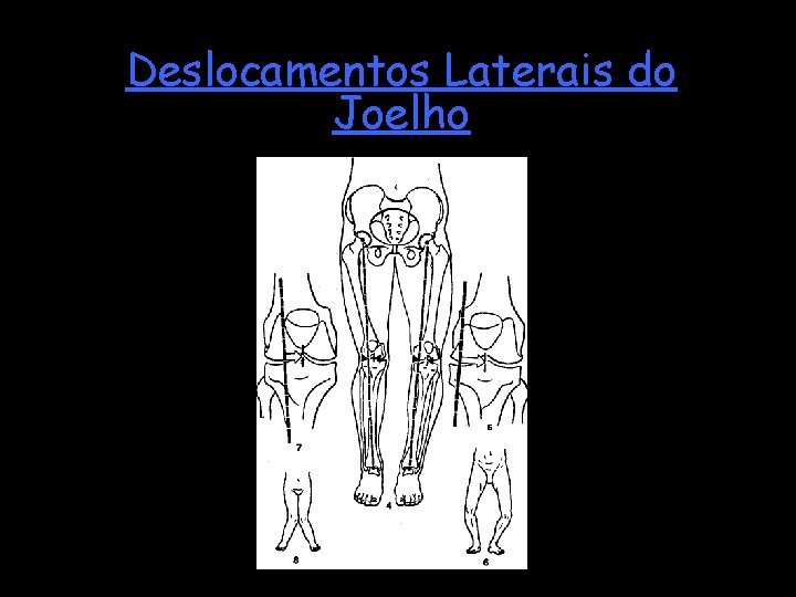 Deslocamentos Laterais do Joelho 