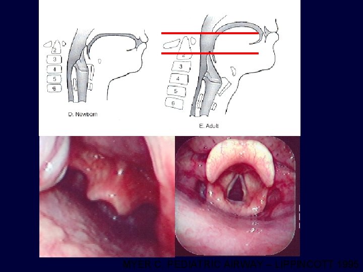 MYER C. PEDIATRIC AIRWAY – LIPPINCOTT 1995 