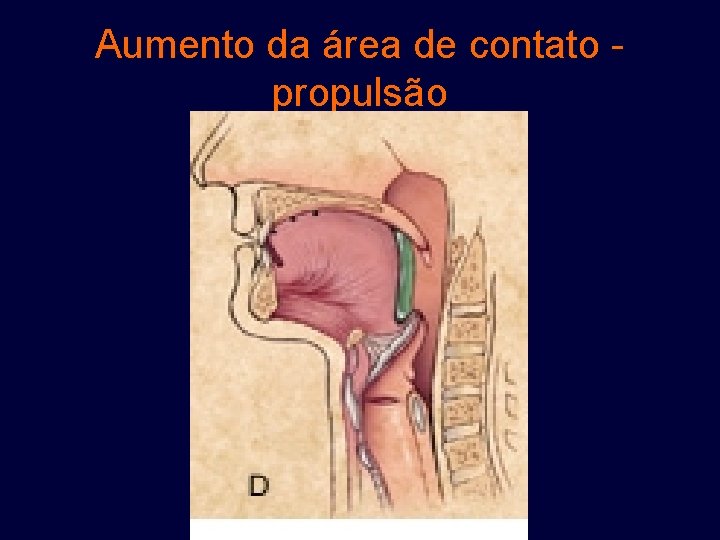 Aumento da área de contato - propulsão 