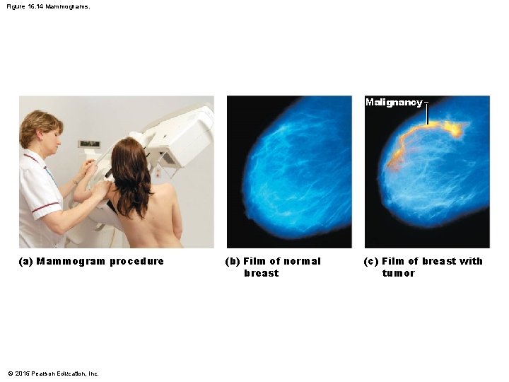 Figure 16. 14 Mammograms. Malignancy (a) Mammogram procedure © 2015 Pearson Education, Inc. (b)