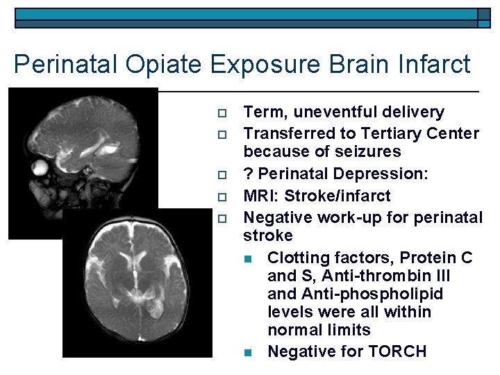 Perinatal Opiate Exposure Brain Infarct o o o Term, uneventful delivery Transferred to Tertiary