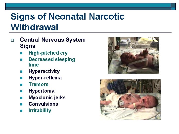 Signs of Neonatal Narcotic Withdrawal o Central Nervous System Signs n n n n