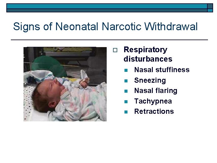 Signs of Neonatal Narcotic Withdrawal o Respiratory disturbances n n n Nasal stuffiness Sneezing