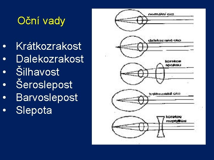  Oční vady • • • Krátkozrakost Dalekozrakost Šilhavost Šeroslepost Barvoslepost Slepota 