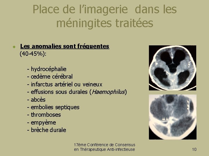 Place de l’imagerie dans les méningites traitées v Les anomalies sont fréquentes (40 -45%):