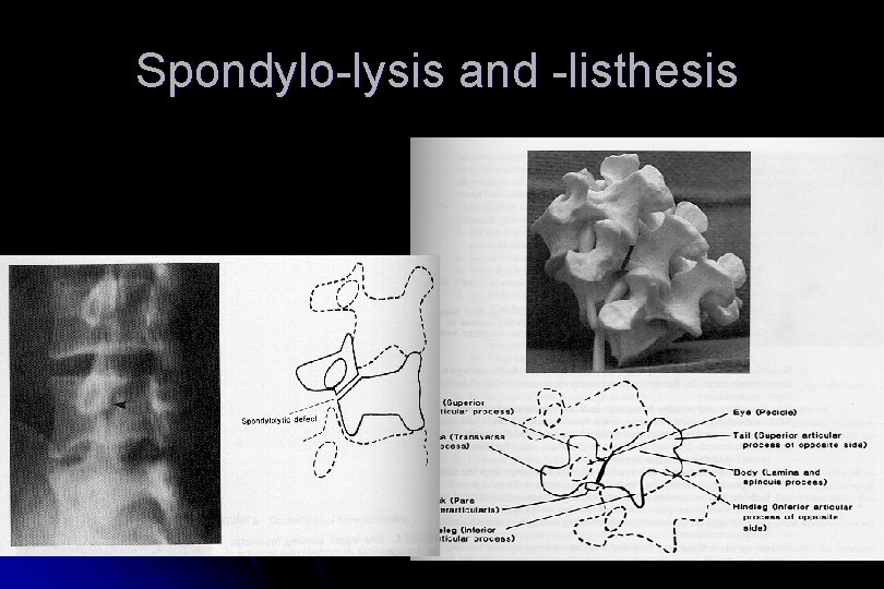 Spondylo-lysis and -listhesis 