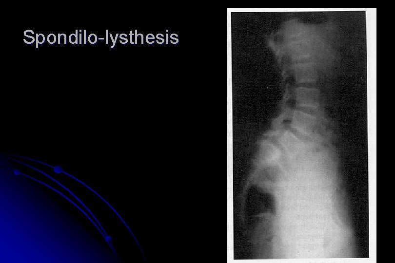 Spondilo-lysthesis 