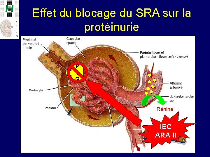 N E P H R O Effet du blocage du SRA sur la protéinurie