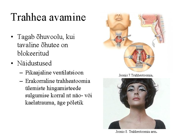 Trahhea avamine • Tagab õhuvoolu, kui tavaline õhutee on blokeeritud • Näidustused – Pikaajaline