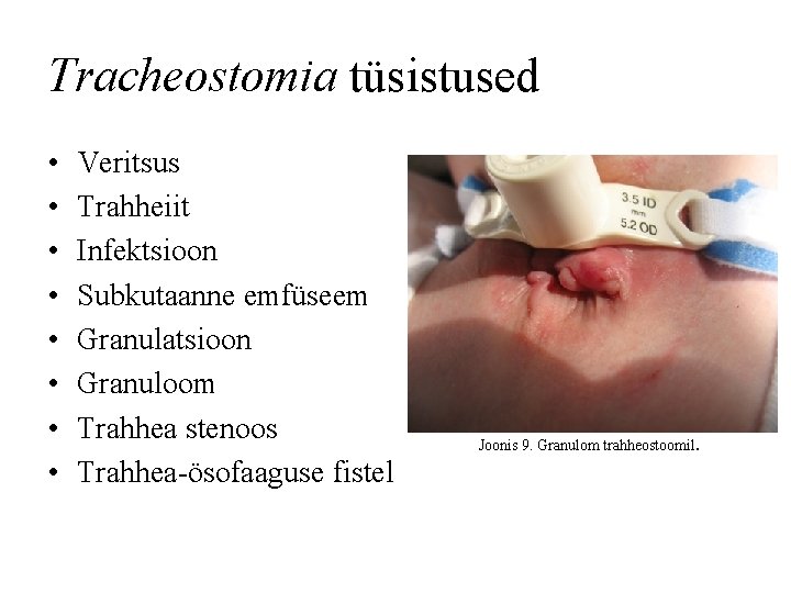 Tracheostomia tüsistused • • Veritsus Trahheiit Infektsioon Subkutaanne emfüseem Granulatsioon Granuloom Trahhea stenoos Trahhea-ösofaaguse