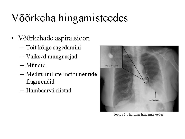 Võõrkeha hingamisteedes • Võõrkehade aspiratsioon – – Toit kõige sagedamini Väiksed mänguasjad Mündid Meditsiiniliste