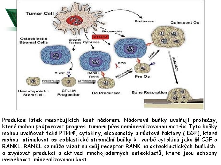 Produkce látek resorbujících kost nádorem. Nádorové buňky uvolňují proteázy, které mohou podporovat progresi tumoru