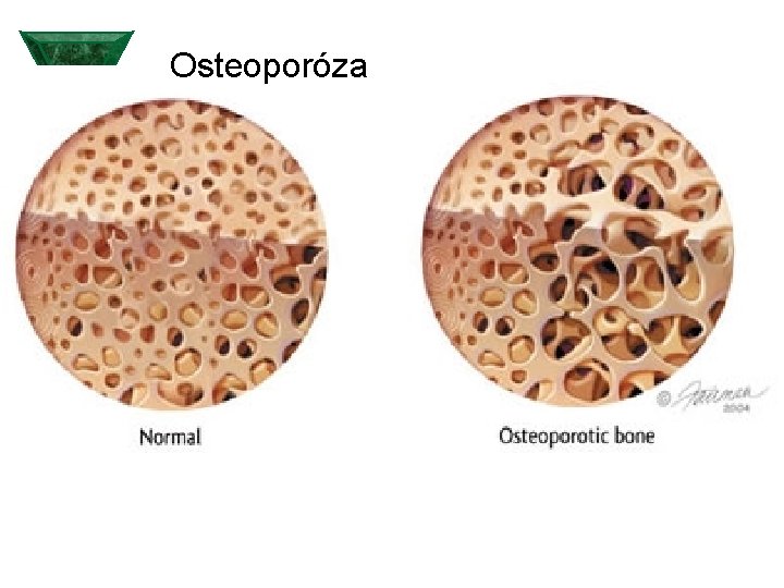 Osteoporóza 