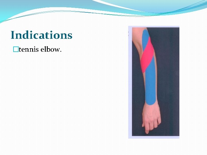 Indications �tennis elbow. 