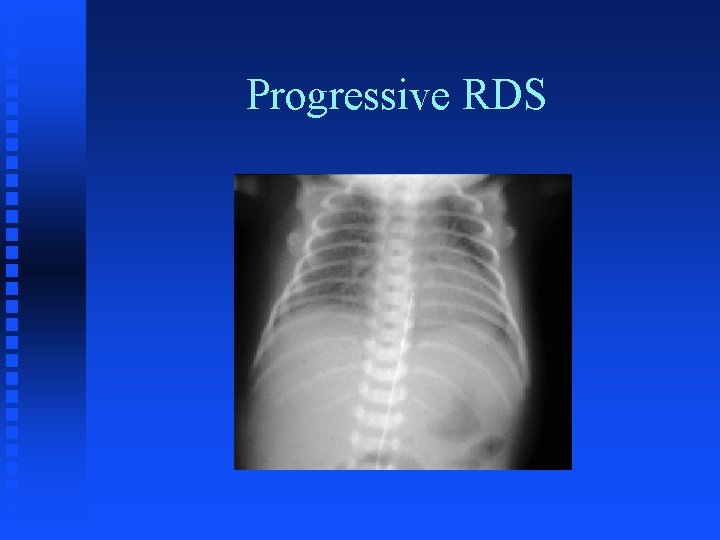 Progressive RDS 