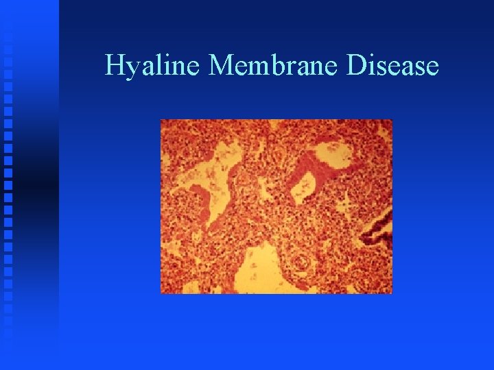 Hyaline Membrane Disease 