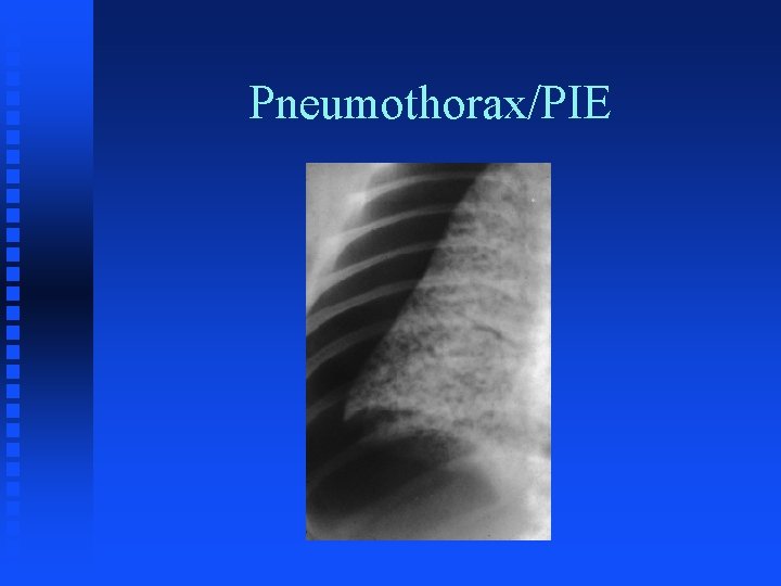 Pneumothorax/PIE 