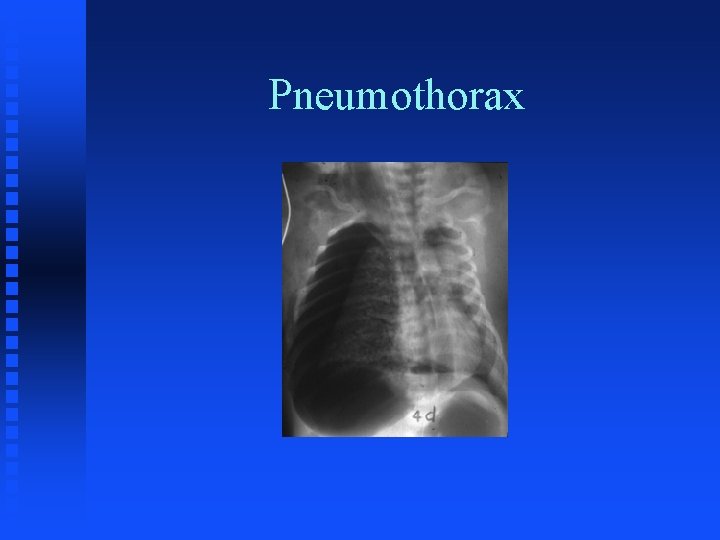 Pneumothorax 