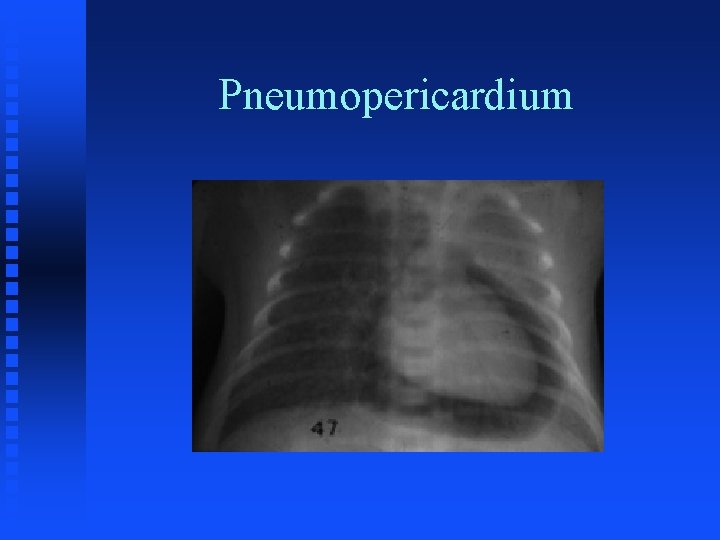 Pneumopericardium 