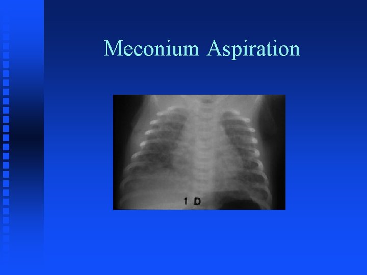 Meconium Aspiration 