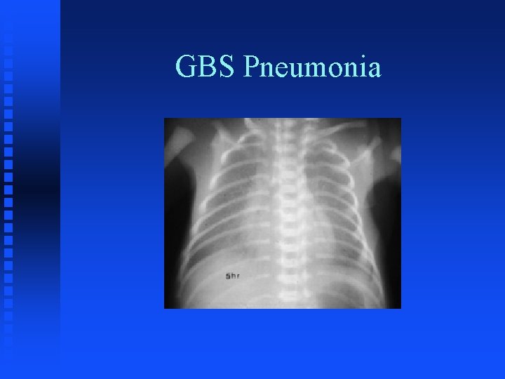 GBS Pneumonia 
