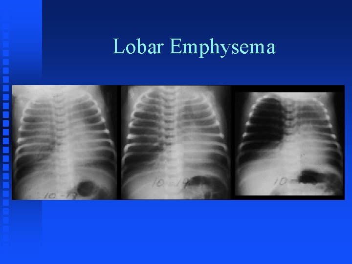 Lobar Emphysema 