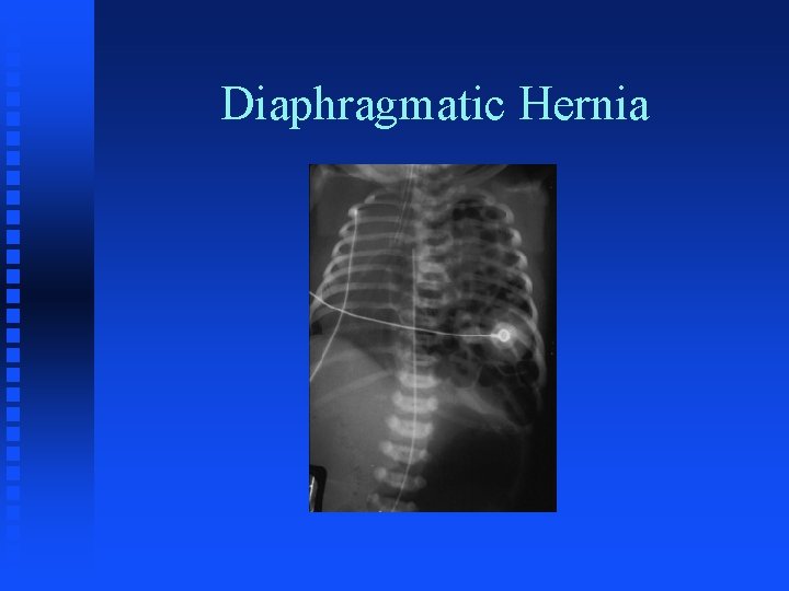 Diaphragmatic Hernia 